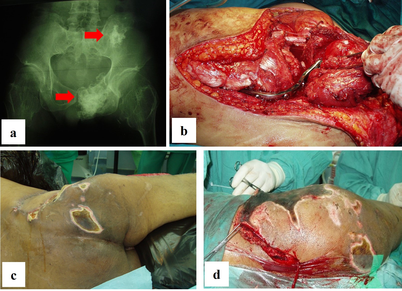 FIGURE 1: In Case #2, the patient had recurrence of left pelvic chondrosarcoma. Plain radiograph showed involvement of the ischiopubic region and ilium, indicated by the red arrows; (a) This led to the decision for an internal hemipelvectomy with hip arthrodesis using plate and screws; (b) However, he subsequently developed chronic wound infections and dehiscence, necessitating multiple debridement; (c & d) which eventually resulted in the decision for an external hemipelvectomy
