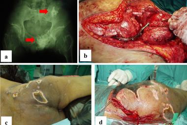 FIGURE 1: In Case #2, the patient had recurrence of left pelvic chondrosarcoma. Plain radiograph showed involvement of the ischiopubic region and ilium, indicated by the red arrows; (a) This led to the decision for an internal hemipelvectomy with hip arthrodesis using plate and screws; (b) However, he subsequently developed chronic wound infections and dehiscence, necessitating multiple debridement; (c & d) which eventually resulted in the decision for an external hemipelvectomy