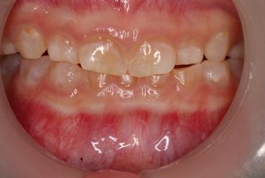 Anterior view of the dentition before treatment