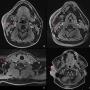 FIGURE 2: MRI images showed (a-c) enlarged and enhancing lymph nodes at levels 2, 3, and 4 of the right cervical neck regions; (d) lobulated soft tissue mass measuring 2.6 cm x 4.9 cm x 6.3 cm in the right pre- and postauricular space