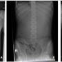 FIGURE 1: (A) Chest radiograph revealed an elevated left hemidiaphragm with absent of gastric bubble; (B) Abdominal radiograph revealed a paucity of small bowel gases that suggest proximal intestinal obstruction; (C) Chest radiograph taken post-intubation revealed bilateral alveolar opacities after the patient aspirated