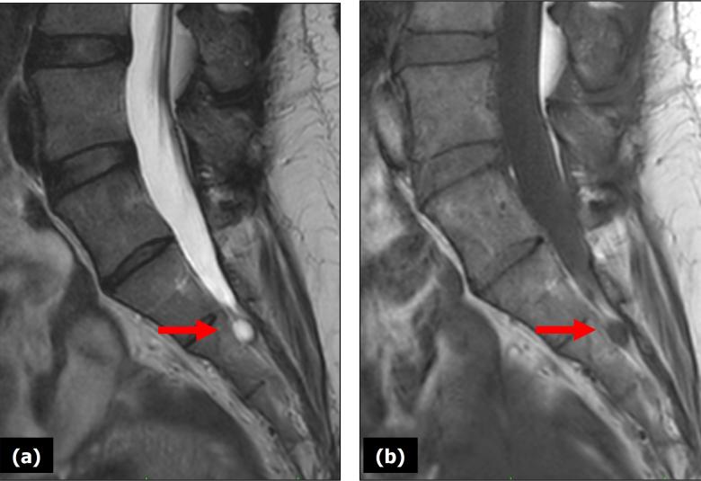 (a) Sagittal T2-weighted and (b) sagittal T1-weighted MRI images of the lumbosacral spine. The red arrows pointed to a Tarlov cyst at the S2 level. On the T2-weighted image, the cyst appearred hyperintense (bright), reflecting its fluid content consistent with cerebrospinal fluid (CSF). In the T1-weighted image, the lesion was isointense to the CSF. The cyst was located within the sacral canal.