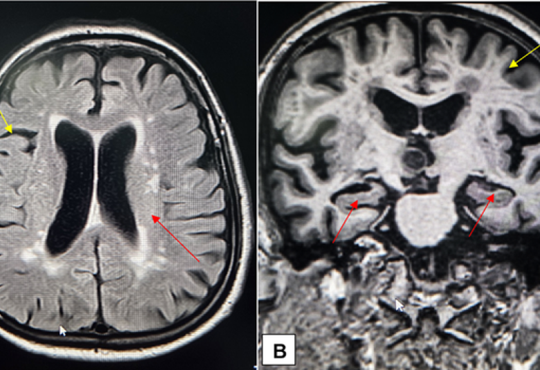 Non-contrast MRI of the patient’s brain showing generalised cortical atrophy (yellow arrows) and loss of hippocampal volume (red arrows) in (A) FLAIR image and (B) Coronal T1 image of the patient’s brain. These structural changes were consistent with neurodegenerative patterns observed in Alzheimer's disease. 
